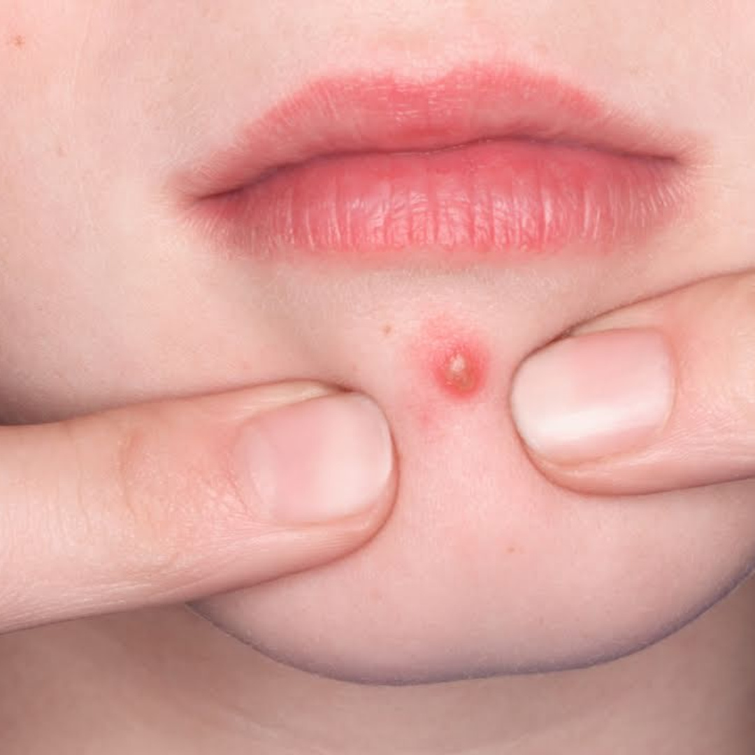 Acne tips