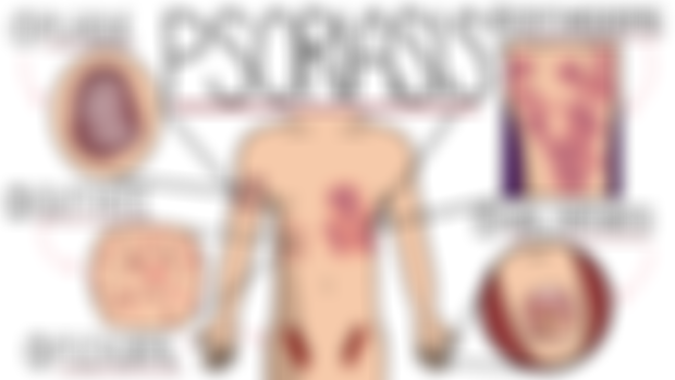 Psoriasis