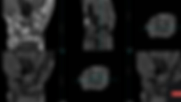 an anatomic variant of the wrist