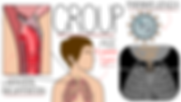 Croup