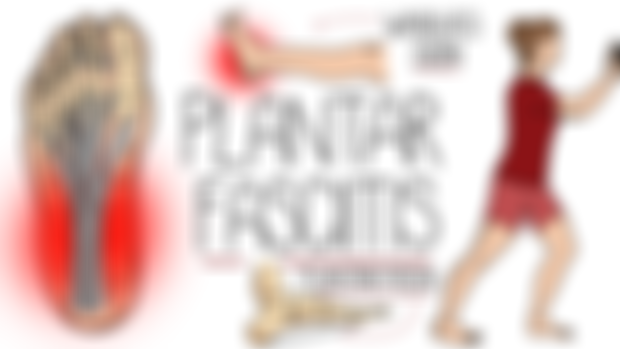 Plantar Fasciitis
