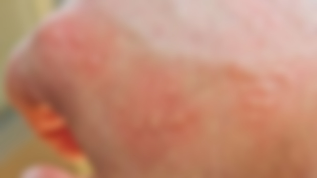 Allergies & Inflammations Morphic Field: Cure Root Cause, Heal Body, Reduce Symptoms, Boost Immunity