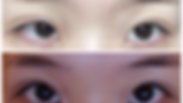eyelid revision 