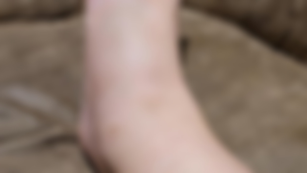 Trail Running Sprain