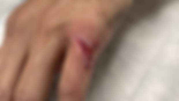 Warning! Semi-gory photo of hand injury!