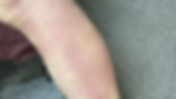 點解病人拍痧棒拍到瘀曬？